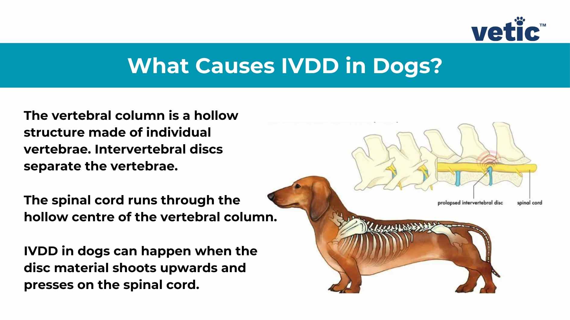 An educational image featuring the title “What Causes IVDD in Dogs?” with the logo of ‘vetic’ in the top right corner. Below the title, there is a paragraph explaining that Intervertebral Disc Disease (IVDD) in dogs is caused by the structure made of individual vertebrae called intervertebral discs separating the vertebrae. It mentions that these discs can harden and press on the spinal cord when they shoot upwards due to degeneration of the vertebral column. On the right side, there are two diagrams illustrating a normal intervertebral disc and a protruded intervertebral disc pressing against the spinal cord. Below, an illustration of a dog with its spine highlighted shows where IVDD can occur.